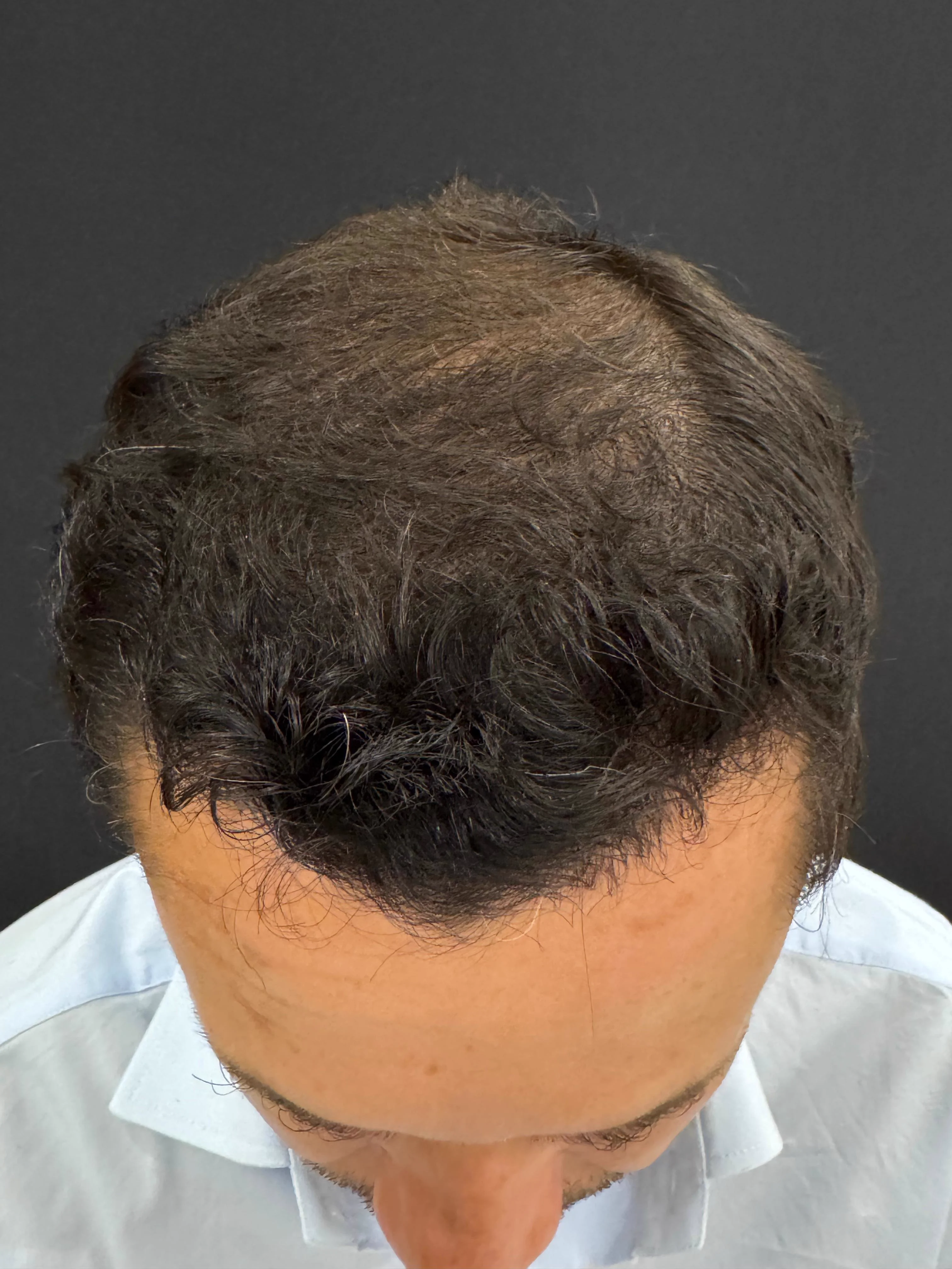 Depois do transplante capilar - resultado 1