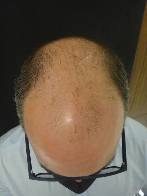 Antes do transplante capilar - resultado 2