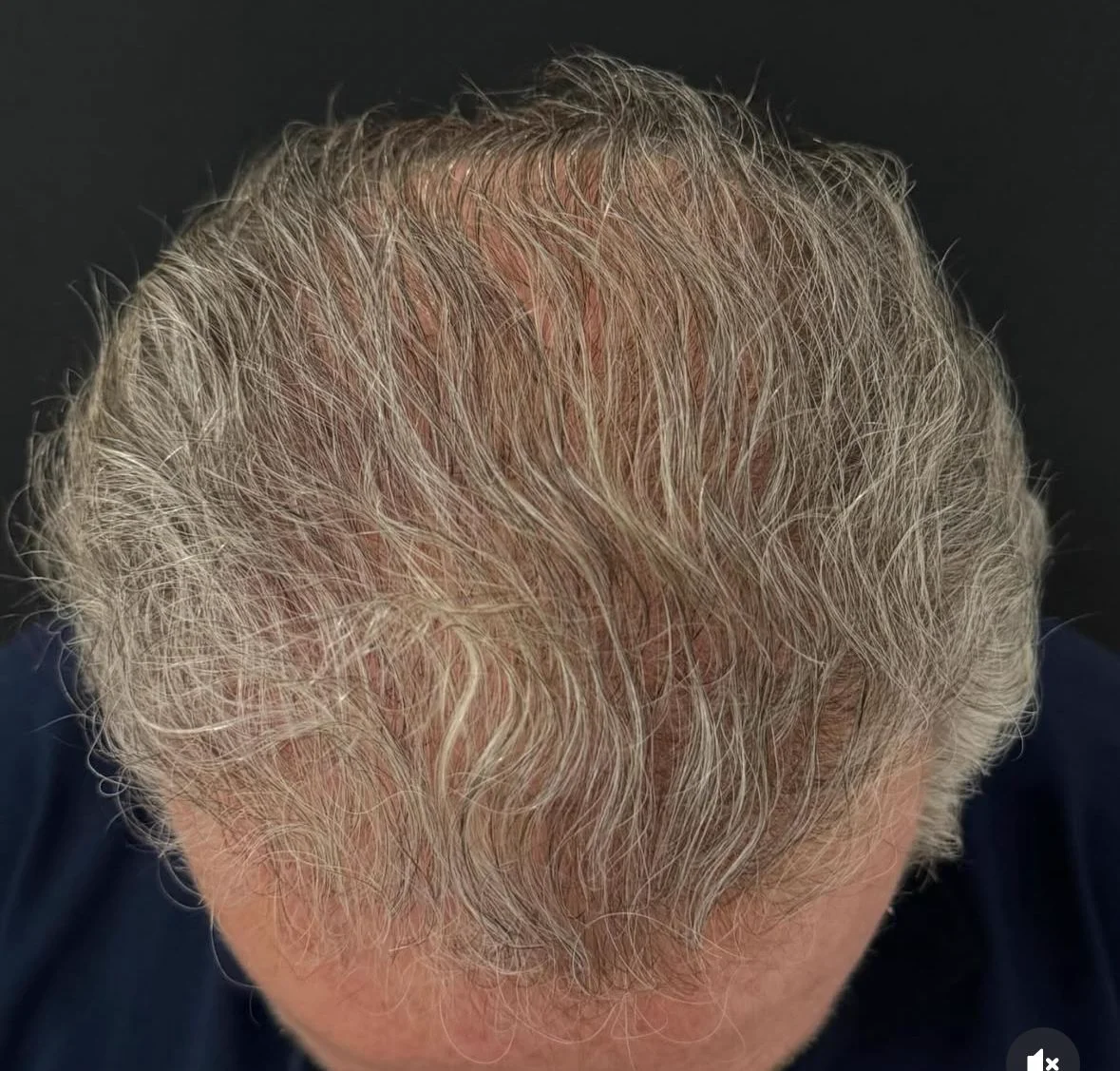 Depois do transplante capilar - resultado 3