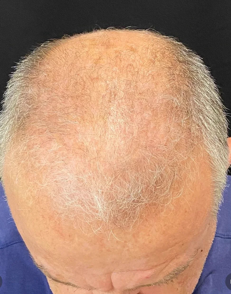 Antes do transplante capilar - resultado 3