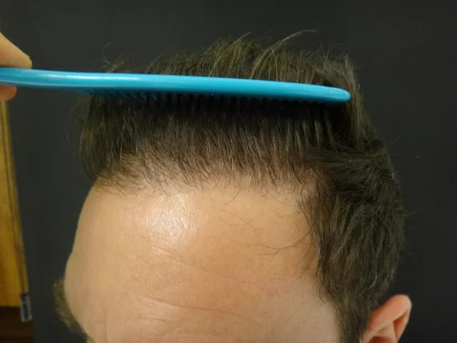 Depois do transplante capilar - resultado 4